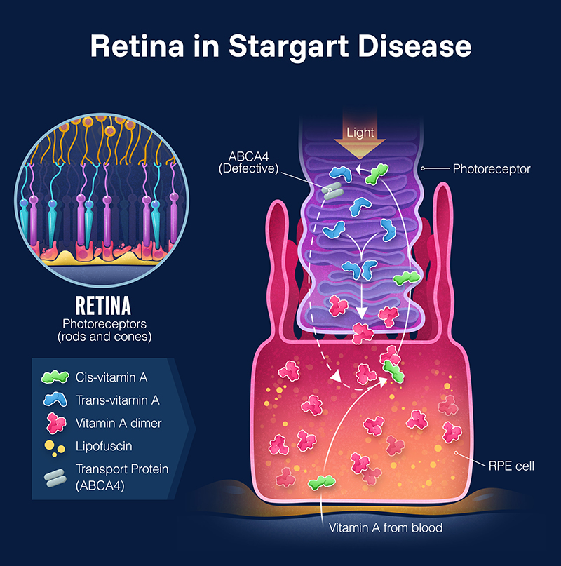 Retina in Stargardt Disease